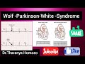 Wolf Parkinson White Syndrome Quick Recap Dr Tharanya Homoeo MRB University Upsc Wolf Parkinson White Syndrome Quick Recap Dr Tharanya Homoeo MRB University Upsc