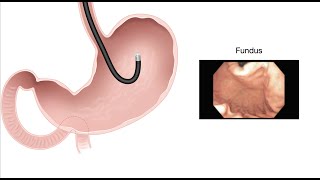 HCC 1475-3b - Stomach - Endoscopy findings of normal anatomy