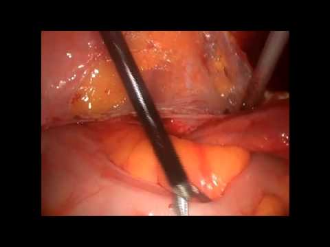 Dr.sabri Kartal Laparoskopik Bilateral Pelvik Lenf  Diseksiyonu (erken Evre Endometriyum Kanseri)