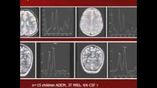 Pediatric ADEM and Transverse Myelitis