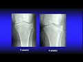 Challenges with tibial plateau fractures - Panel case discussion