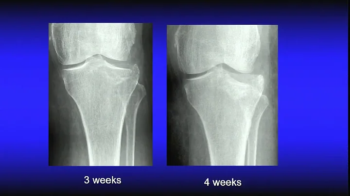 Challenges with tibial plateau fractures - Panel c...