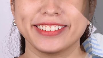 Khắc phục tình trạng cười hở lợi | Nha Khoa Hoa Mỹ