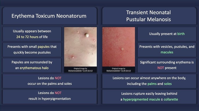 Pustular Melanosis
