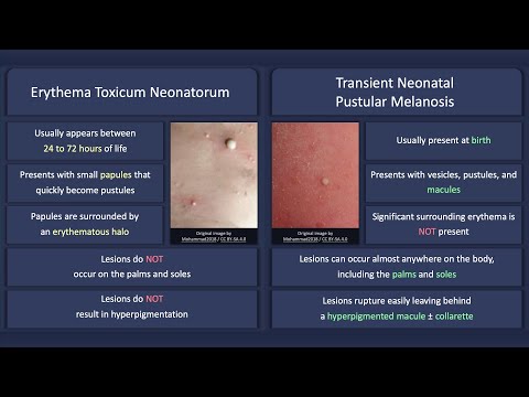 Video: Neonatal erythema