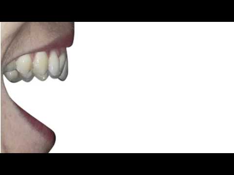 Vídeo: Luxació Dental O Pèrdua Sobtada En Gossos