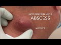 Not ripened neck abscess. Painful firm nodule with deep pocket on neck. I+D with packing. MrPopZit