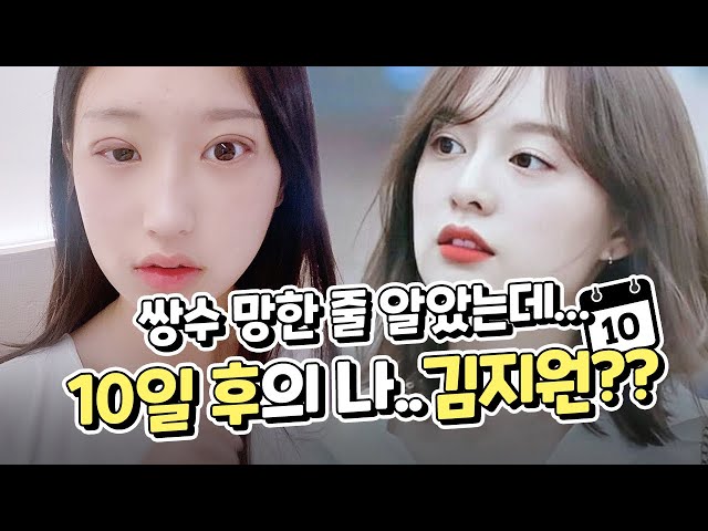 [쌍수] 쌍수 망한 줄 알았는데😱 10일 만에 연예인 된 썰😮 (매몰 10일차 경과 리뷰)