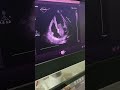 Echocardiography #LA Mass or Thrombus