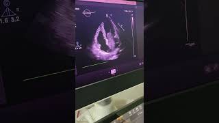 Echocardiography #LA Mass or Thrombus