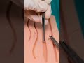 Vertical Mattress Suture Surgerystepbystep Dr Surgicalsutures 