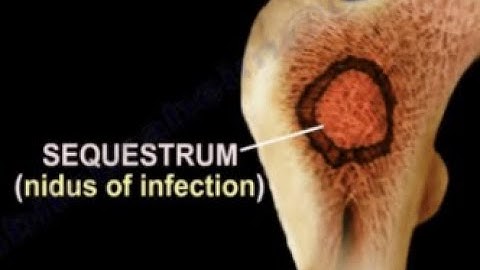 Partial Excision of Bone CPT code - simplify medical coding