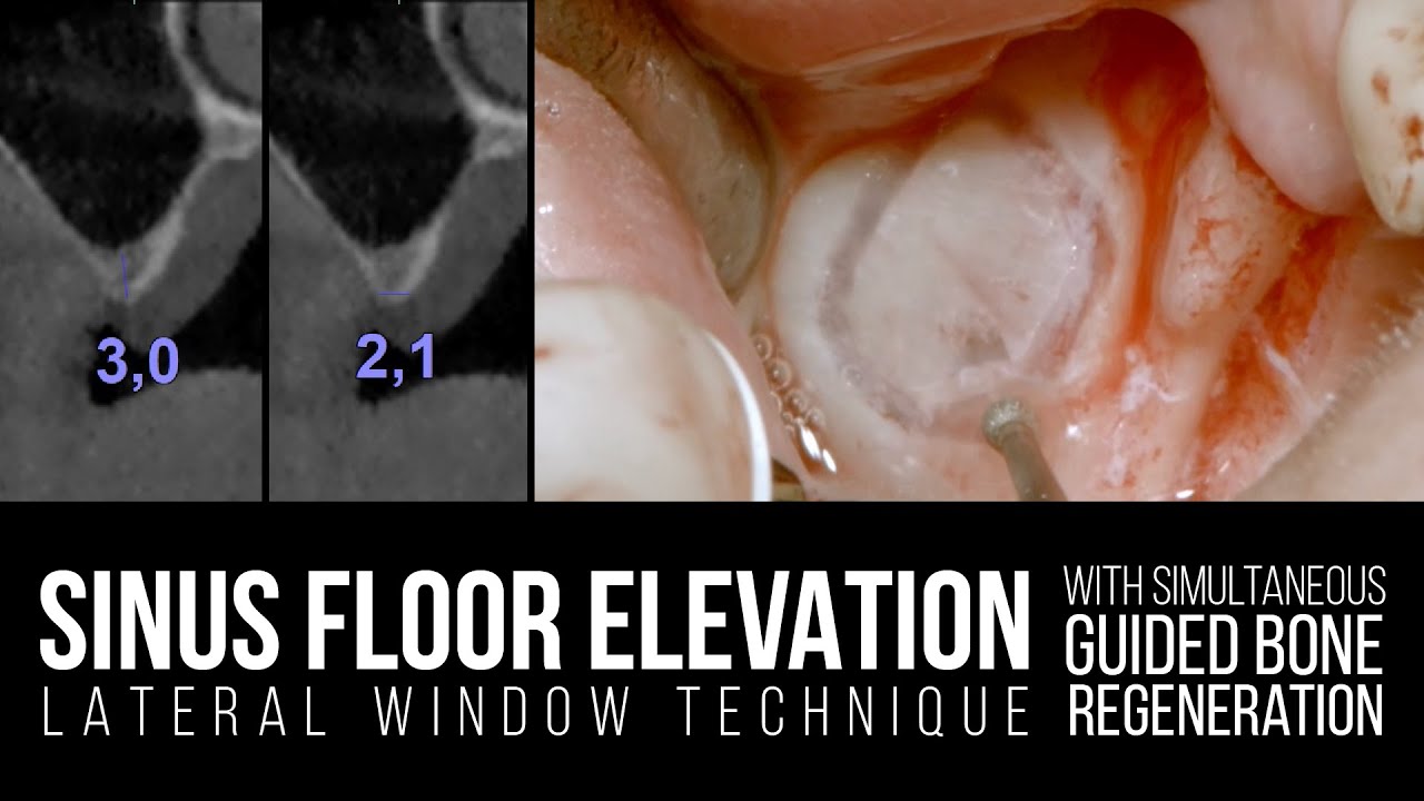 Maxillary Sinus Lift with Lateral Window Technique and Simultaneous GBR ...