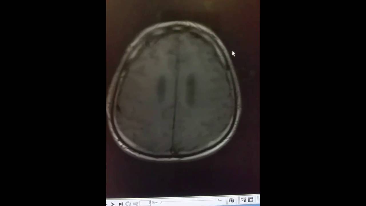 Colloid cyst of the brain.  Spot diagnosis