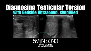 Diagnosing Testicular Torsion with Bedside Ultrasound, simplified