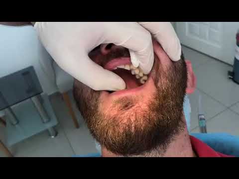 3 köklü azı dişi çekimi.   -3 root molar extraction-