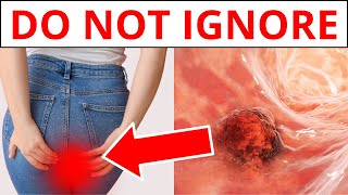 9 Early WARNING Signs Of Colon Cancer You Should NOT Ignore