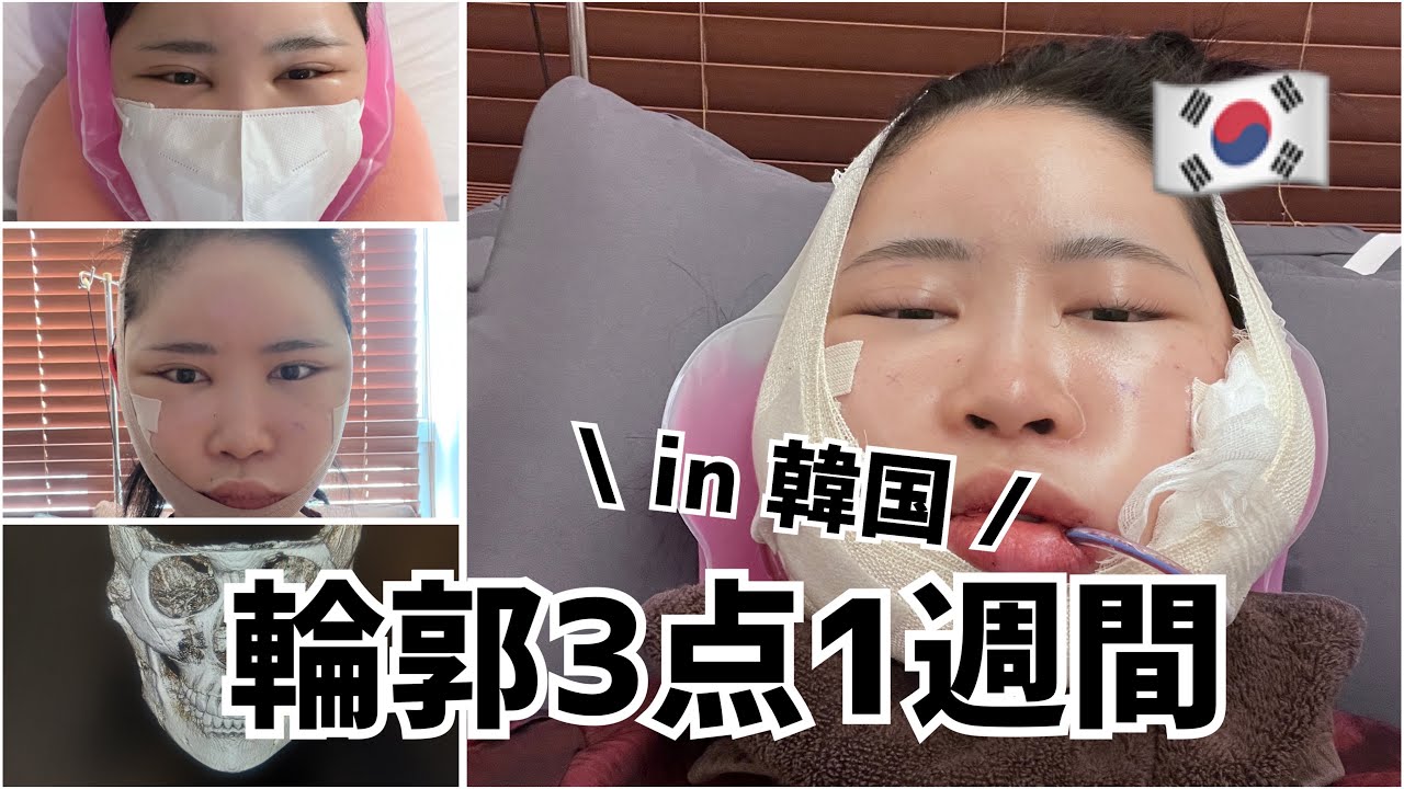 【韓国】輪郭3点壮絶過ぎる1週間