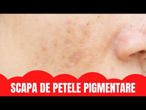 Video: Cum se folosește crema pentru pete?