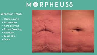 Morpheus8 Inmode Waiting Room Video