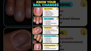 Your Nails May Be Warning You About These Health Problems