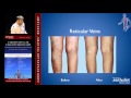 Diagnosis and management of varicose veins mitul patel md