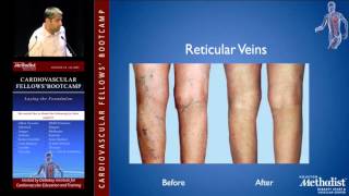 Diagnosis and Management of Varicose Veins (Mitul Patel, MD)
