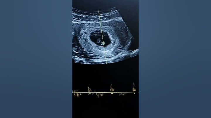 FRECUENCIA CARDÍACA FETAL EN EMBRIÓN DE 6 SEMANAS
