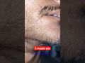 beard growth5 month use #mars #marsbyghc #minoxidil #minoxidil5 #face
