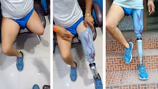 #abovekneeamputee #belowkneeamputee #artificiallimb #legprosthesis #prosthetics #handprosthesis