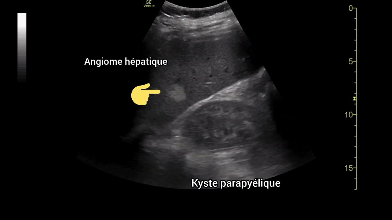 Angiome hépatique et kyste parapyélique