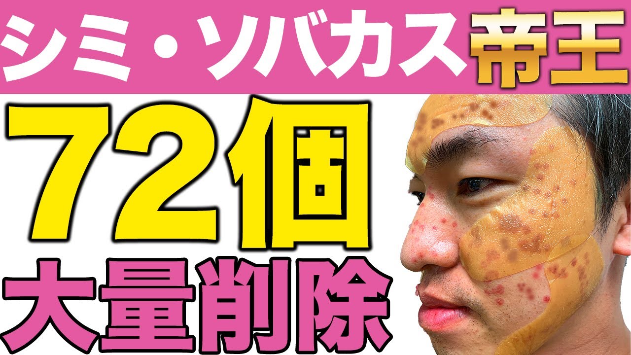 【シミ除去】顔の大量シミ・ソバカスレーザーで消します！