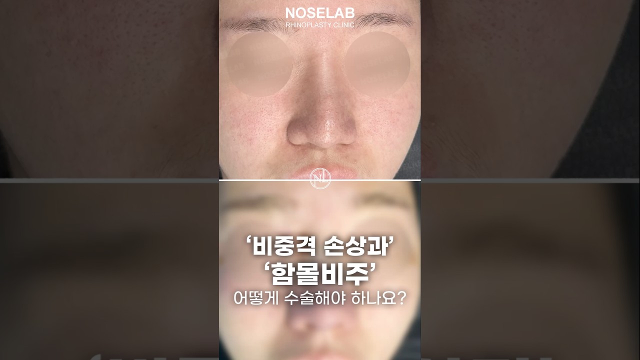 비중격 손상 재건, 자가늑연골 코재수술로 코끝&middot;비주&middot;호흡까지 회복할 수 있을까?