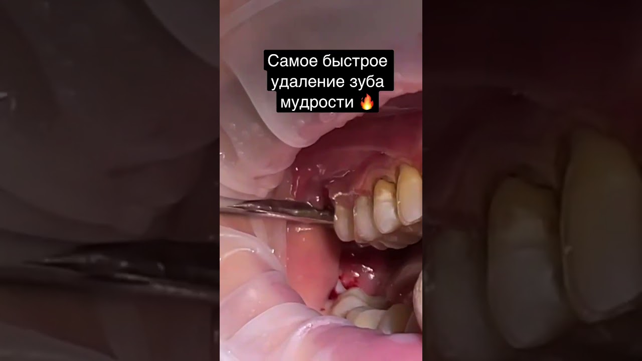 Самое быстрое удаление зуба мудрости в МИРЕ?🤯😭#шортс #стоматология #хирург