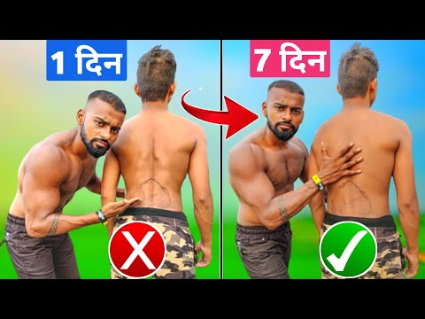 How to Fix Anterior Pelvic Tilt - कमर के गड्ढे को ठीक करें - Fix Back Posture