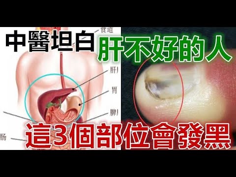 肝不好，臉上會有3大症狀，多吃三種食物，排出肝毒，修復肝臟！