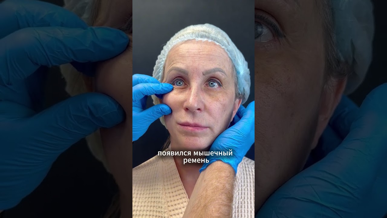 Как исправить последствия неудачной блефаропластики!