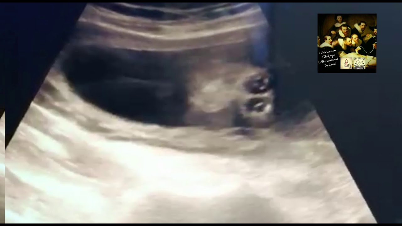 Cyclopia roboscis Abnormal spine (cervical spina bifida, short spine)