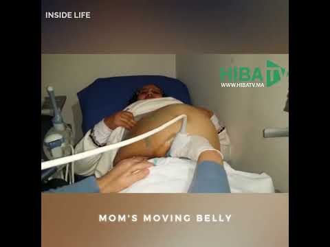 The belly of the #pregnant mom moving during the medical examination. 🤰 😲