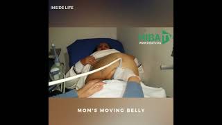 The belly of the #pregnant mom moving during the medical examination. 🤰 😲