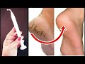 ये तरीका 1 दिन में फटी एड़ियां से छुटकारा पाये! Cracked Heels Home Remedy / Crack Heels Treatment