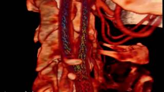 Amira | 3D visualization and analysis | 3D visualization of Simulated Blood Flow