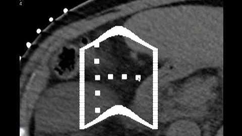 Compact Robotically Steerable Image Guided Robot for Multi Adjacent Point MAP Targeting
