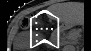 Compact Robotically Steerable Image Guided Robot for Multi Adjacent Point MAP Targeting