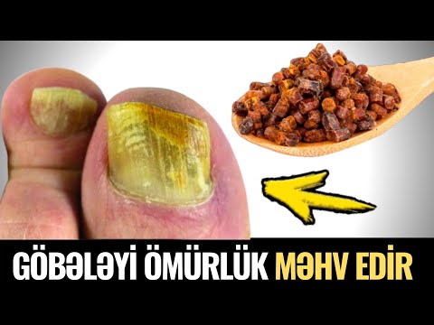 Video: Adi Ot Göbələyi: Çəmən Göbələklərini Müəyyən Edin və Yox Edin