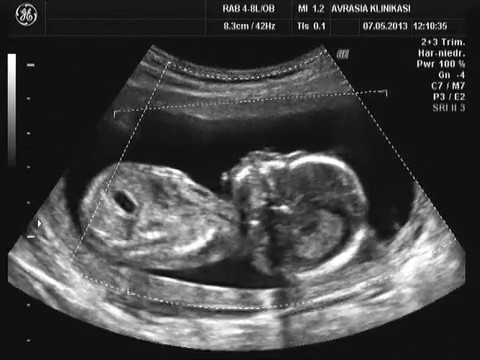 Узи 6 месяцев. Снимок ребенка на УЗИ 9 месяцев. УЗИ снимок 6 месячного ребенка. Снимок УЗИ беременности 9 месяцев.
