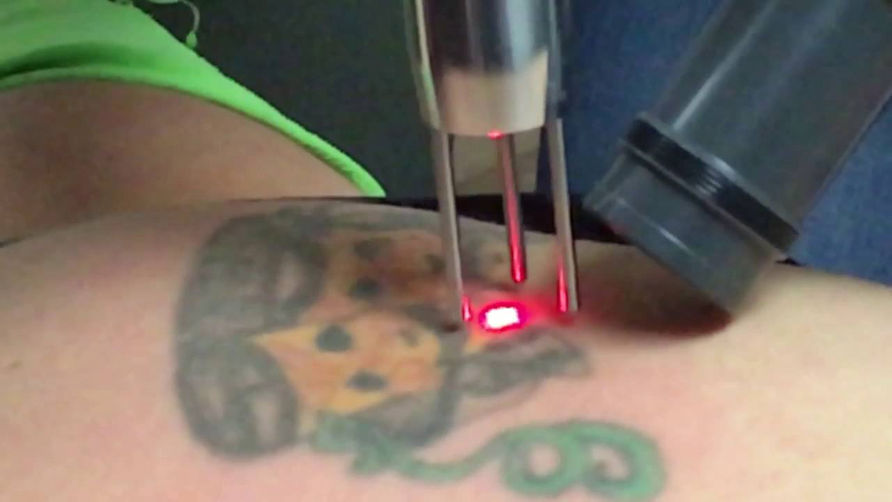 laser tattoo removal phoenix az youtube laser tattoo removal phoenix az youtube