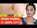Shrink PORES with Amazing Toner! Large Clogged Pores open pores treatment best toner for open pores