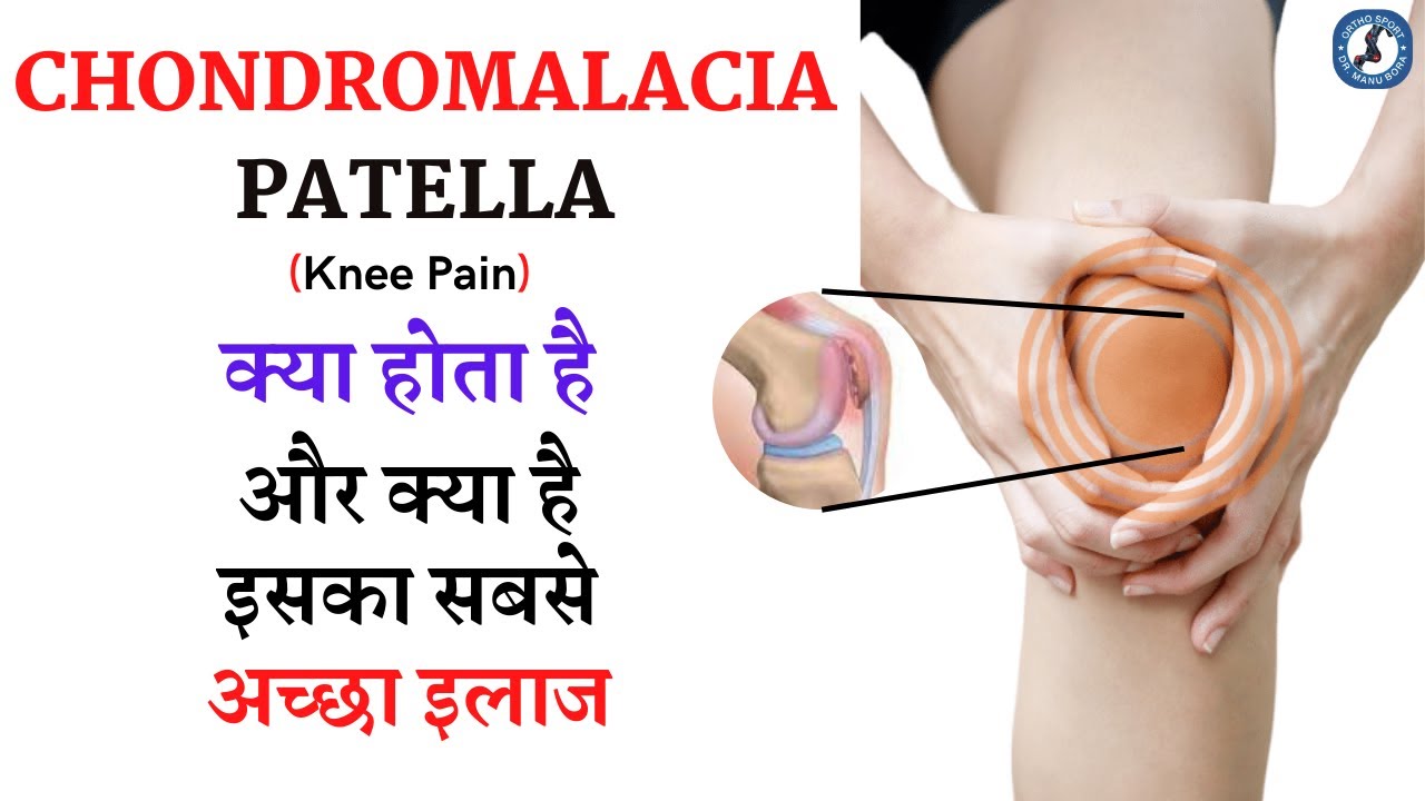 Chondromalacia patella क्या होता है ? और क्या है इसका सबसे अच्छा इलाज