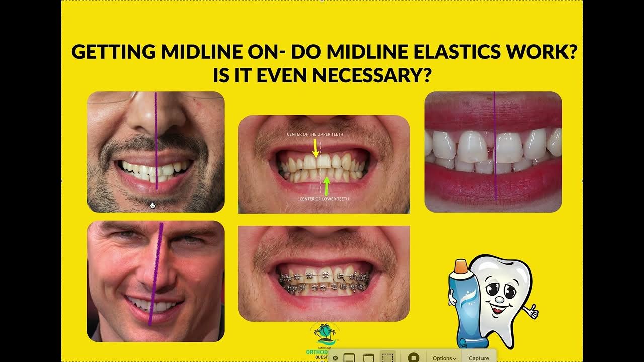 Getting Midlines on Invisalign/ Braces / Midline Elastics YouTube